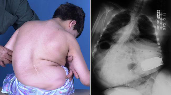 What is Neuromuscular Scoliosis? – Lake City Times